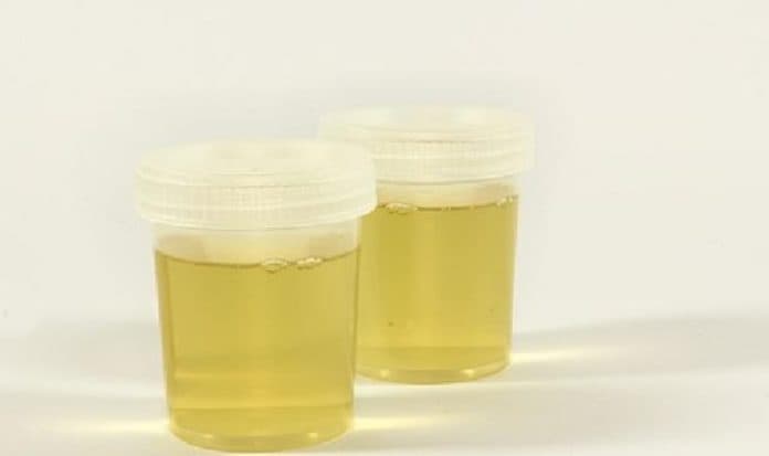 indikasi_dan_penyebab_risiko_urine_berdarah