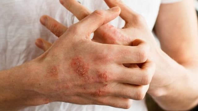 waspadai_penyakit_kulit_saat_musim_hujan